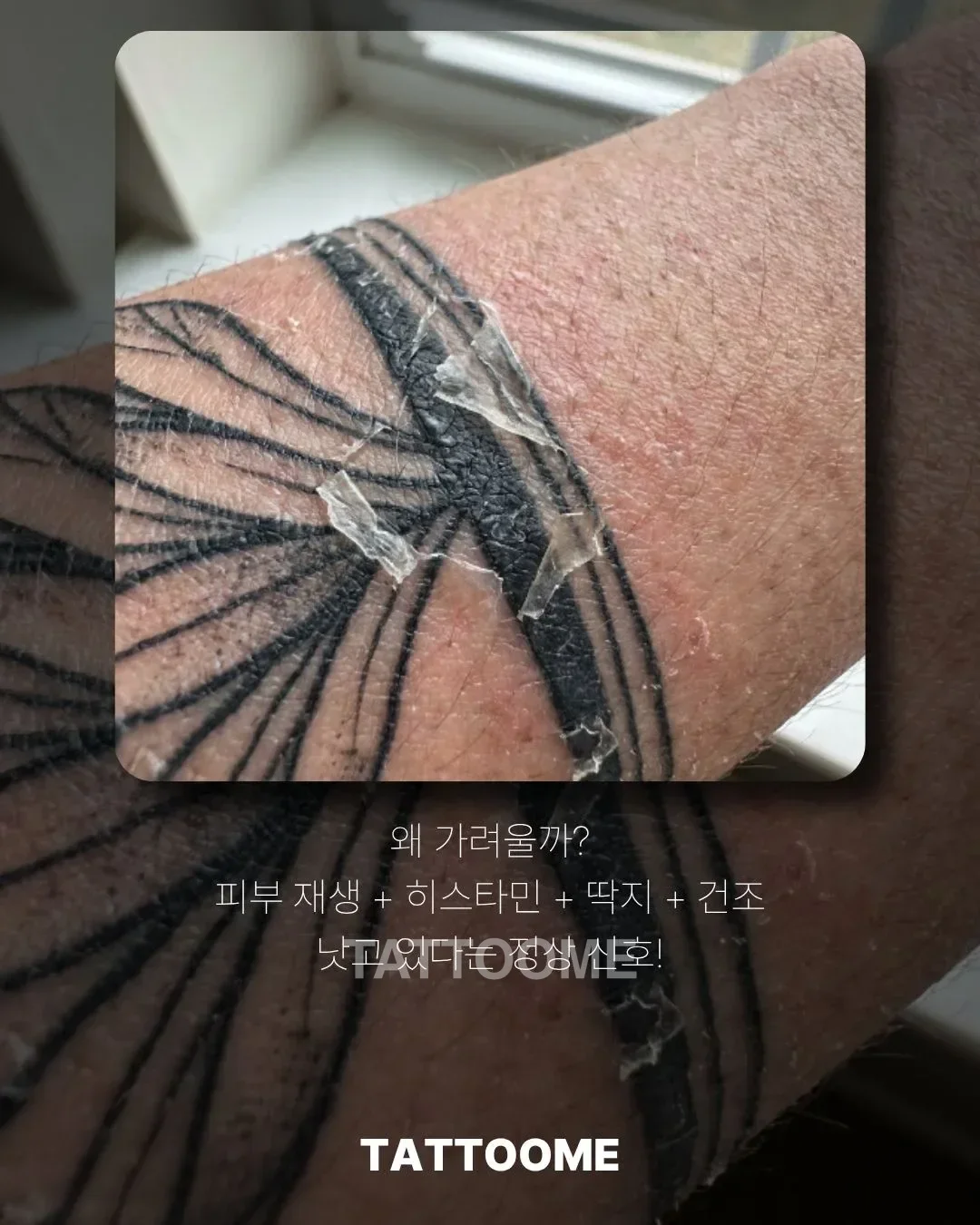 타투 가려움이 생기는 원인
