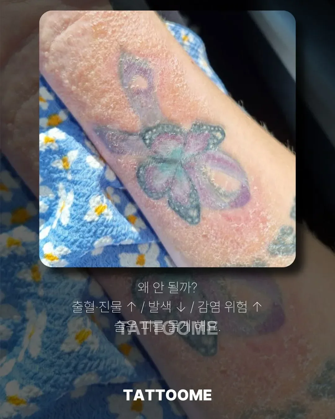 타투 후 회복 중 음주가 미치는 영향